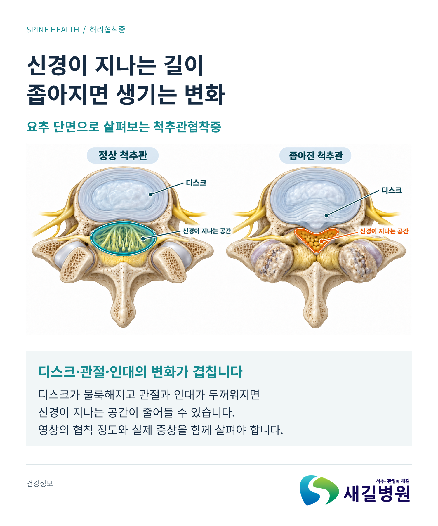 허리협착증, 걷다가 다리가 저릴 때 확인할 3가지 | 새길병원