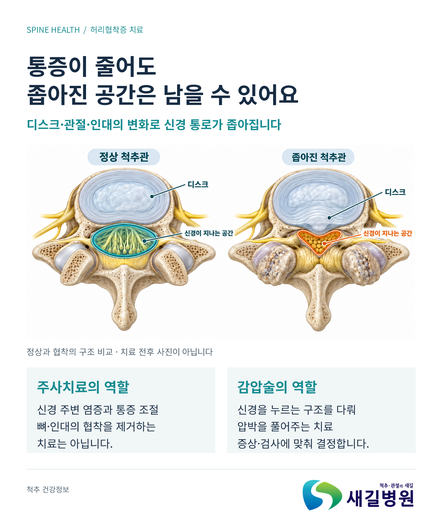 협착증 주사 후 다시 저릴 때 확인할 3가지 | 새길병원